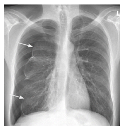 * puncture to pleural membrane causes air (pneumo) in pleural space

\
Intrapleural pressure = atmospheric pressure

* doesn’t change with thoracic cage expansion
* lung is no longer under tension + collapses

\
==Blood== in this space is called a ==hemothorax==

treatment:

* reseal the hole + get lung to expand

  BUT
  * this can be dangerous because if the pressure in the intrapleural space returns to normal, this can shift the positions of the organs in the thorax = very bad😔