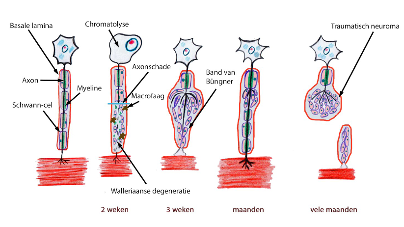 <ul><li><p>Walleriaanse degeneratie</p><ul><li><p>na beschadiging (of doorsnijden) van axon:</p><ul><li><p>distale deel van axon gaat degenereren</p></li><li><p>proximale deel van axon degenereert tot aan eerstvolgende knoop van Ranvier</p></li><li><p>myelineschede rond degenererende axon degenereert &amp; desintegreert</p></li></ul></li><li><p>gedegenereerde axon &amp; myeline dan opgeruimd door macrofagen</p></li><li><p>Schwann-cellen zelf sterven niet af → delen zich &amp; proliferen binnen perineurium</p></li></ul></li><li><p>bij beschadiging van axon: veranderingen waargenomen in perikaryon dat hoort bij axon:</p><ul><li><p>perikaryon zwelt</p></li><li><p>chromatolysis</p><ul><li><p>= verlies van Nisslse substantie</p></li></ul></li><li><p>kern komt excentrisch te liggen</p></li><li><p>spiervezels geïnnerveerd door beschadigde axon: atrofiëren</p></li></ul></li><li><p>bij regeneratie van axon:</p><ul><li><p>terug toename van Nisslse substantie</p></li><li><p>zwelling van perikaryon verdwijnt</p></li></ul></li><li><p>na 3-tal weken:</p><ul><li><p>regenererende axonen groeien traag in kolommen gevormd door prolifererende Schwann-cellen</p><ul><li><p>Schwann-celkolommen = banden van Bünger</p></li></ul></li><li><p>snelheid waarom axon regenereert → overeenkomend met deze van trage axonale transport</p><ul><li><p>± 1mm per dag</p></li></ul></li></ul></li><li><p>na meerdere maanden: succesvolle regeneratie van zenuwvezel mogelijk</p><ul><li><p>terug functionele connecties met dwarsgestreepte spiervezels gevormd</p></li><li><p>spiervezels gaan herstellen</p></li></ul></li><li><p>amputatieneuroom/ traumatisch neuroom</p><ul><li><p>bij amputaties of grote onderbrekingen van zenuwvezels → prolifererende Schwann-cellen kunnen defect niet overbruggen</p></li><li><p>uiteinde van beschadigde zenuw: toont wanordelijke proliferatie van Schwann-cellen met ertussen takjes van axonen die proberen te regenereren</p></li><li><p>je kan afstanden overbruggen (bv. hand eraanzetten), maar geen extreme afstanden (bv. arm eraan zal niet lukken)</p></li></ul></li></ul><p></p>
