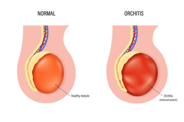 <p>Orchitis</p>