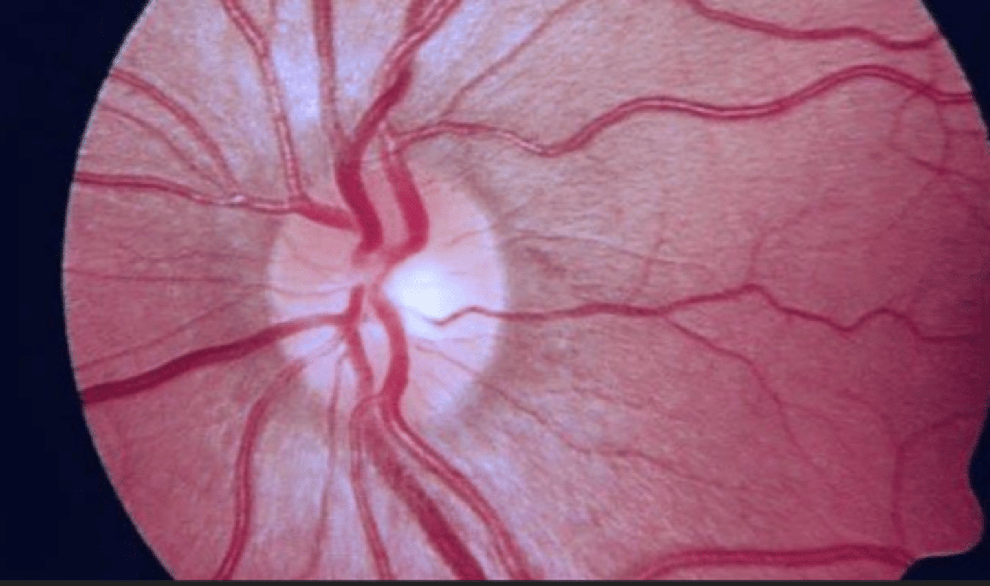 <p>ocular signs, such as retinal hemorrhage or retinal vessel enlargement may indicate what circulatory problem?</p>