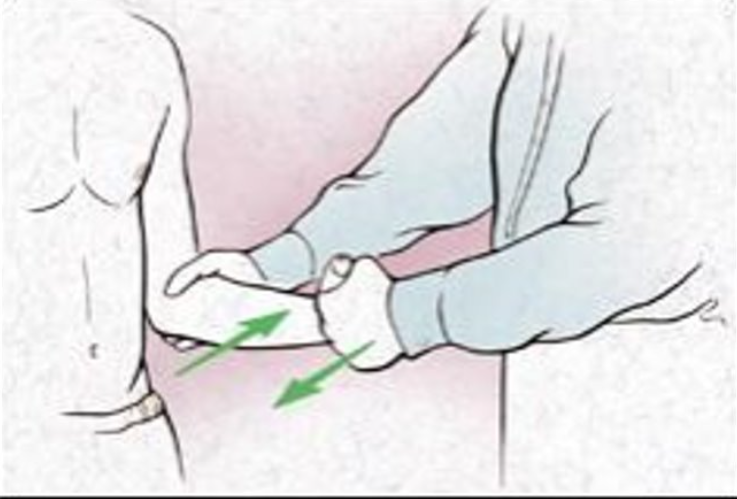 <p><span>To assess the subscapularis muscle for tendinitis, strain or weakness​​</span></p><p class="Paragraph WhiteSpaceCollapse SCXP83501276 BCX0" style="text-align: left"><span><strong>Steps:</strong>​</span></p><ol><li><p class="Paragraph WhiteSpaceCollapse SCXP83501276 BCX0" style="text-align: left"><span>Place the client in a seated or supine position, with the humerus by the side of the body and the elbow flexed to 90 degrees.​</span></p></li><li><p class="Paragraph WhiteSpaceCollapse SCXP83501276 BCX0" style="text-align: left"><span>Apply pressure to the client's wrist in the direction of external rotation, while the client attempts to internally rotate the wrist.​</span></p></li></ol><p><span><strong>Positive Sign</strong>: Pain along subscapularis or weakness</span></p><p><span>does not distinguish between subscapularis, pectoralis major, latissimus dorsi and teres major strength</span></p>