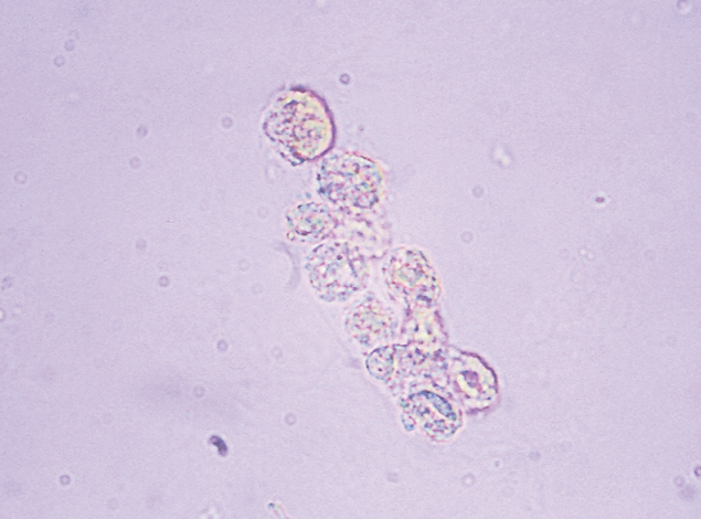<p>Casts containing RTE due to advanced tubular destruction</p>