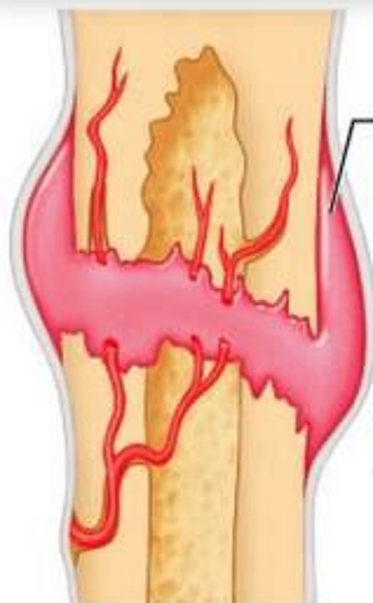 <p>blood clot that forms at the site of a broken bone</p>