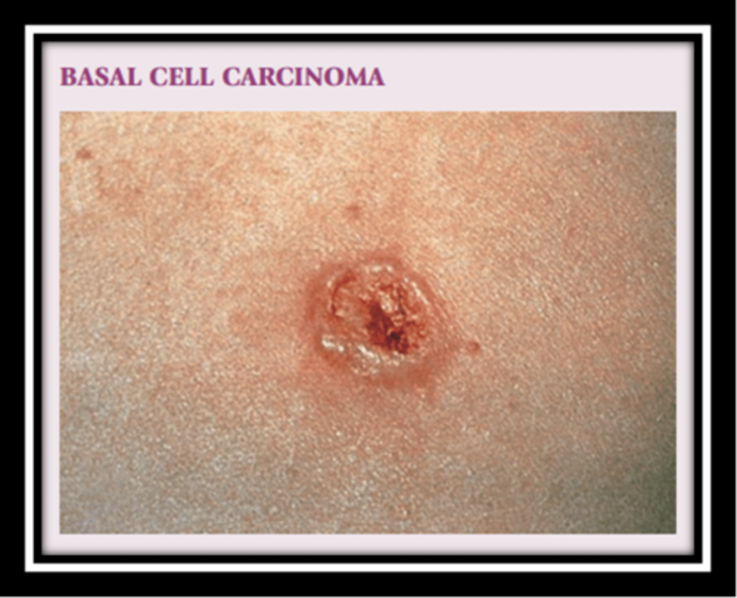 <p>Slow-growing and locally invasive</p><p>Translucent (pearly)papule or nodule with a depressed center and rolled edges</p><p>Caused by the sun</p><p>Most common cutaneous malignancy</p>