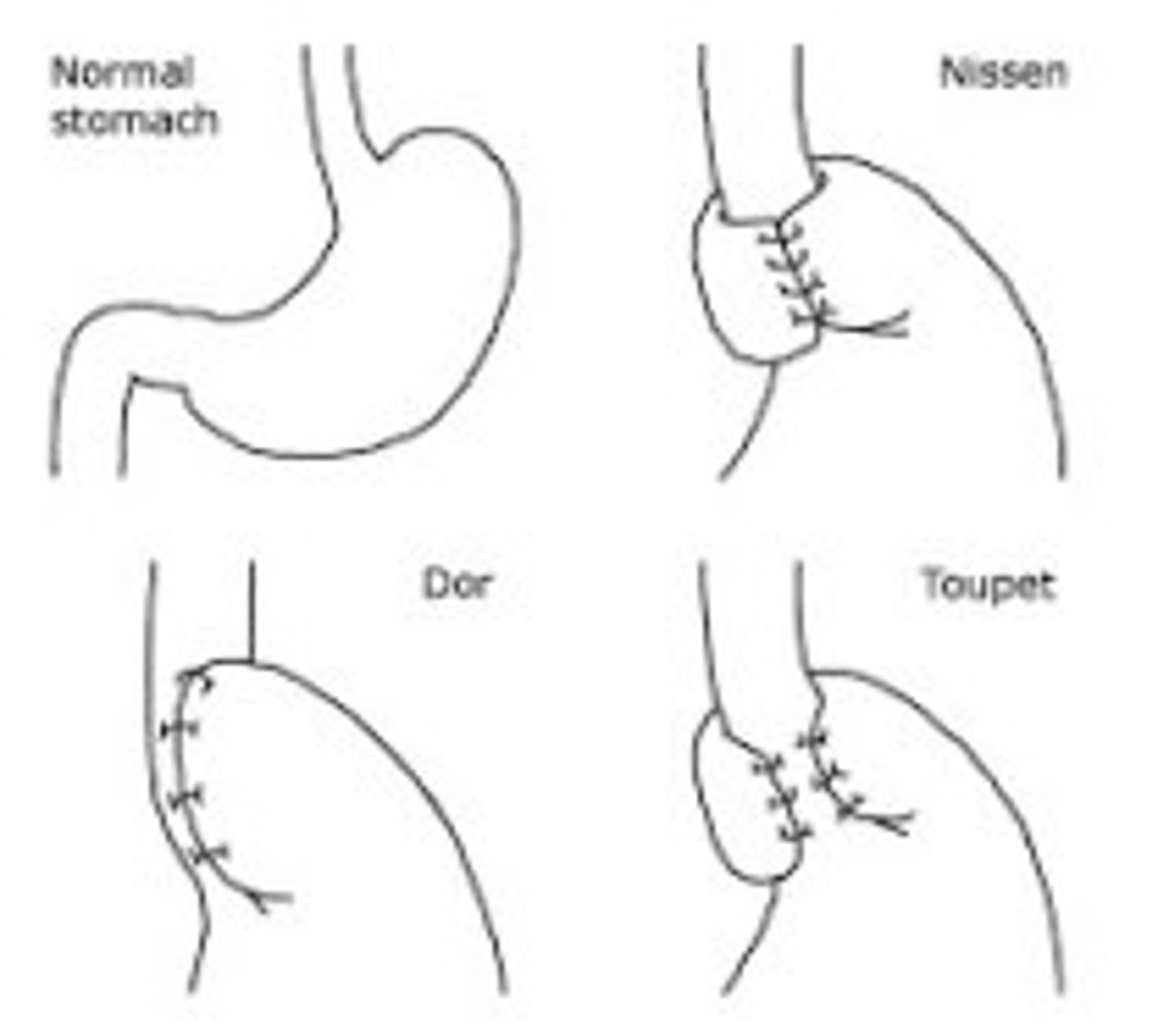 <p>Nissen 360 back wrap</p><p>Dor: 180 front</p><p>Toupet: 270 back</p>