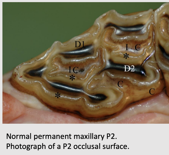 <p>Colloquially called a "cup“ in teeth</p><p></p><p>Looks like a dark mark, because food gets packed inside and turns black as it decays</p><p></p><p>Partly filled with cement, leaving a small cavity</p><p></p><p>Does not connect with the pulp cavity</p><p></p><p>Secondary dentin is formed overlying the pulp horn (dark brown D2)</p><p></p><p>Primary dentin (white/yellowish D1)</p>