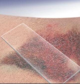 <p>what type of lesion is depicted</p>