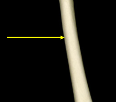 <p>The long, tubular shaft of a long bone that provides structural support and houses bone marrow. </p>