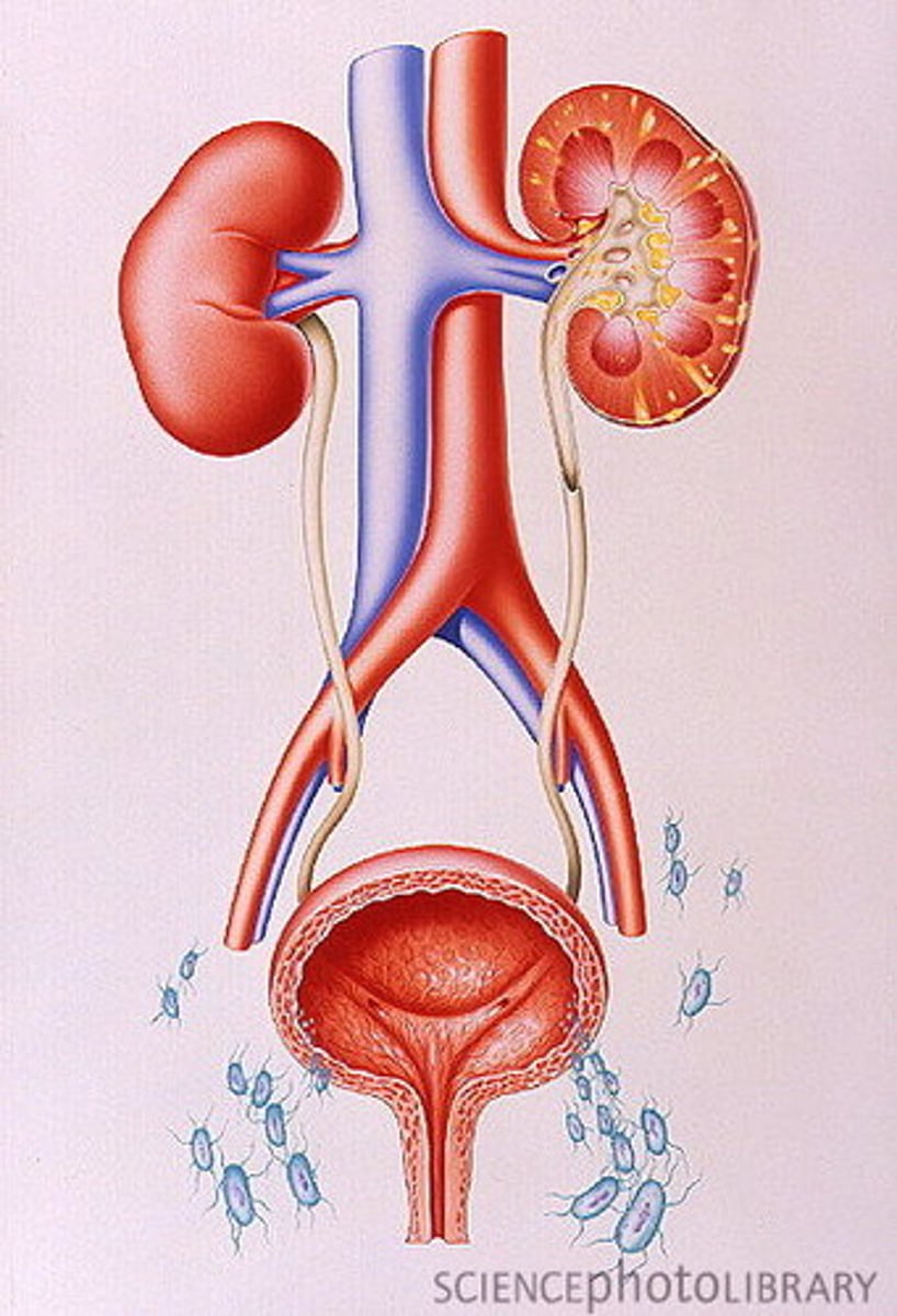 <p>struvite from infection</p>