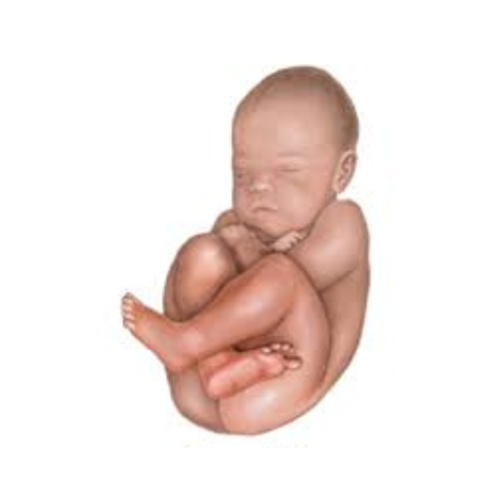 <p>Complete breech</p>