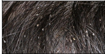 <p>Infestation of lice and their eggs (nits); can occur in the scalp, hair, eyelashes, and genital area.</p>