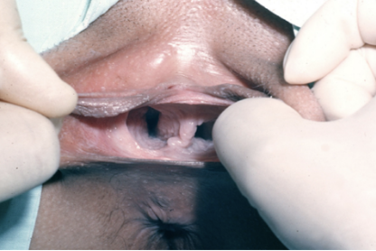 <p>What specific female “embryonic structures” is affected and probably has incurred insult during its entire course of development that have led to this congenital defect affecting the patient’s external genitalia (check the picture: a case of DISTAL BICOLPOS or DOUBLE HYMENAL OPENINGS WITH DOUBLE VAGINA OF THE LOWER 2/3rd’s):</p><p>A. Sinovaginal Bulbs</p><p>B. Unaleria</p><p>C. Wolffian Ducts</p><p>D. Müllerian Ducts</p>