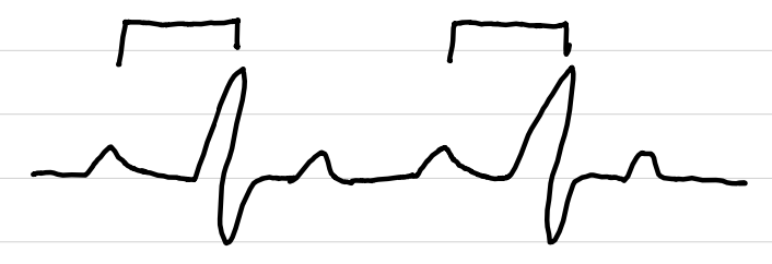 <ul><li><p>rate: any</p></li><li><p>rhythm: any</p></li><li><p>P waves: normal</p></li><li><p>PR interval: <span style="color: red;">>0.20 sec</span></p></li><li><p>QRS complexes: <0.10 sec</p></li><li><p>ST segments: normal</p></li></ul><p></p>