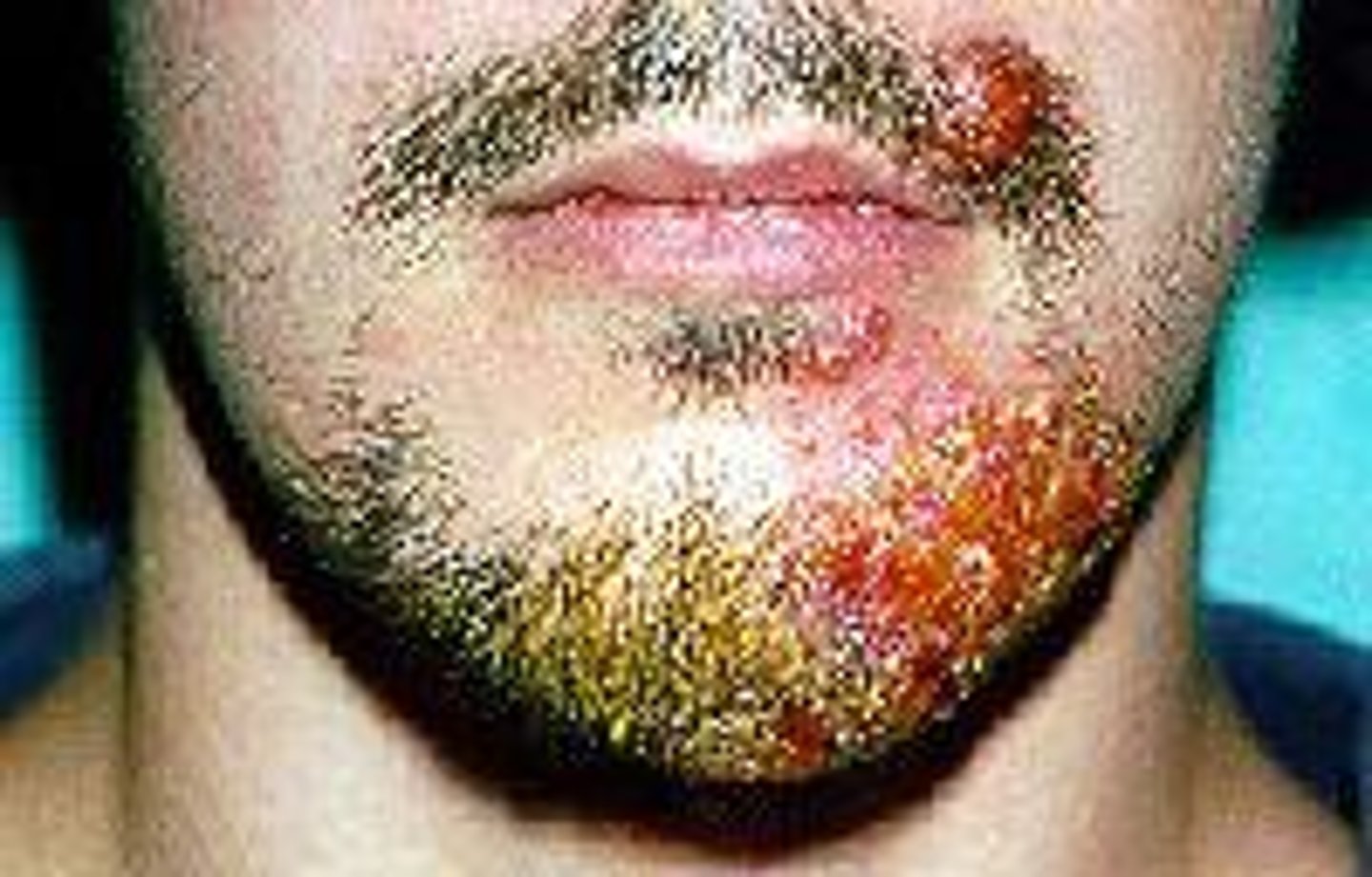 <p>a superficial fungal infection caused by a variety of dermatophytes that commonly affects the skin</p>