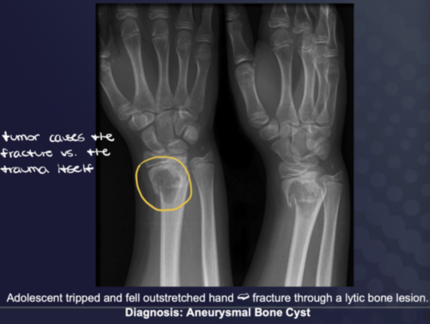 <p>Tumor, osteoporosis, infection, Paget's disease</p>