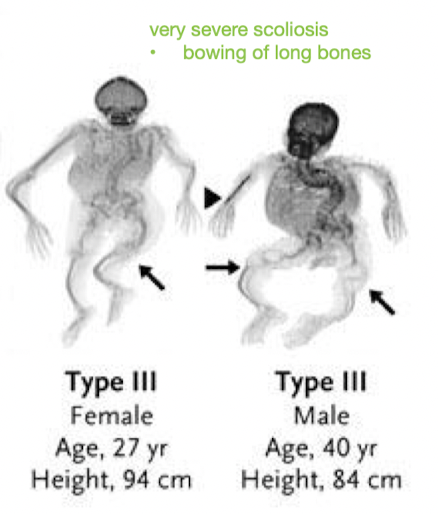 <p>Is <em><u>OI Type III</u></em> often autosomal dominant or recessive inheritance?</p><p>___ presentation?</p><p>Progressive deformity of long ___, skull, and ___ = short stature</p><p>How does type III affect teeth?</p><p>Hearing loss?</p><p>How is the kyphoscoliosis?</p><ul><li><p>what may it result in?</p></li></ul>