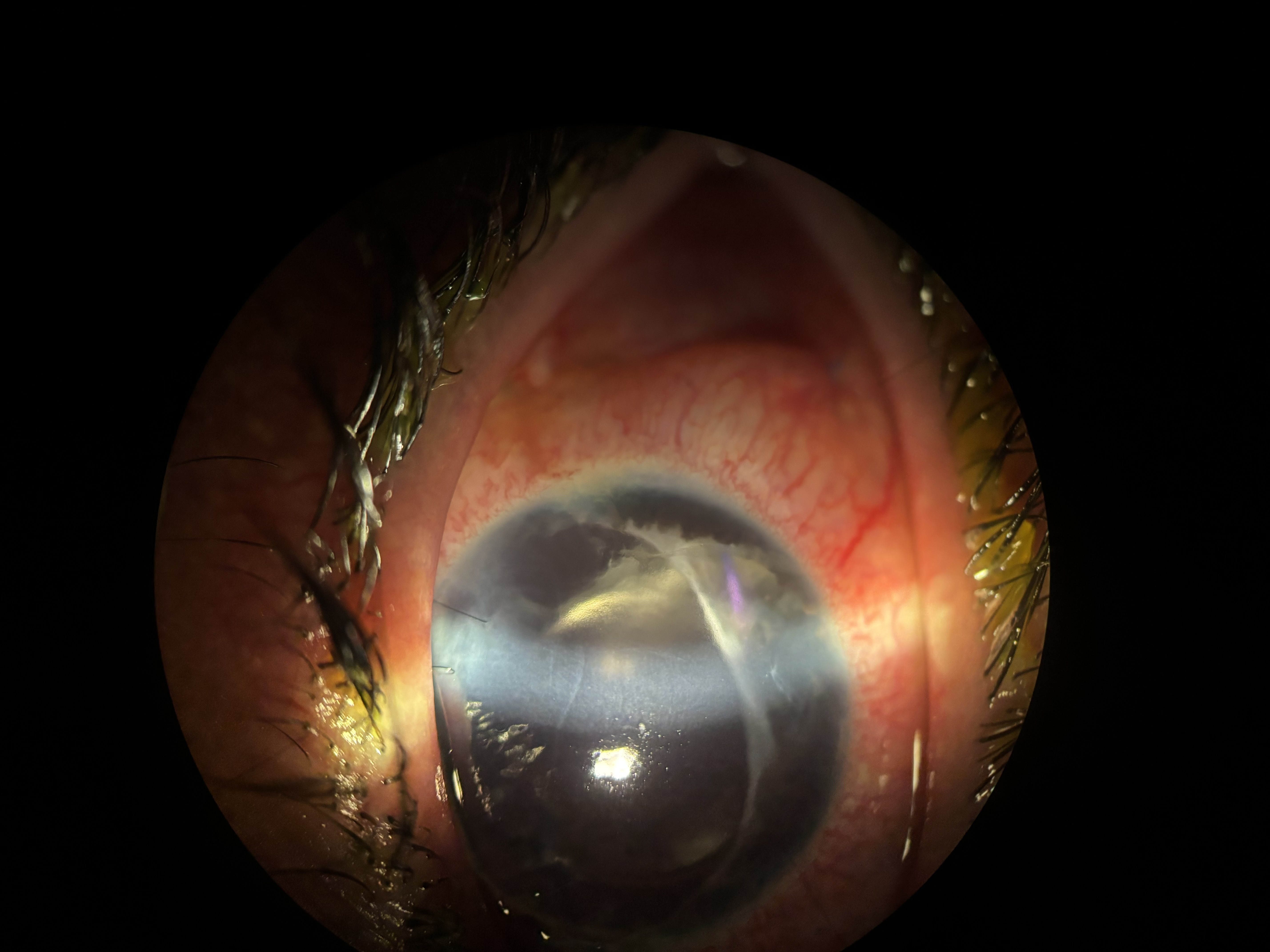 <p>Collateral vessels that form in response to retinal ischemia, often seen in retinal vein occlusion.</p>