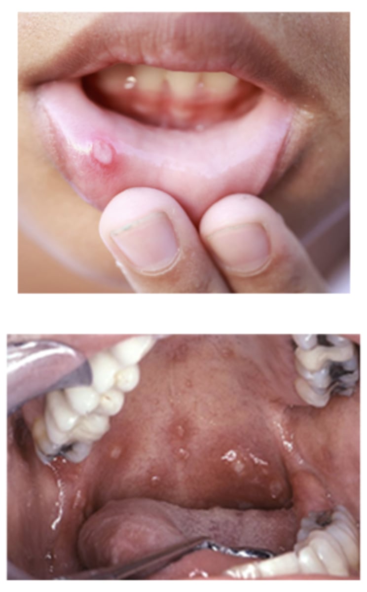 <p>__________ is also called "canker sores", can be solitary or multiple</p>