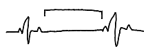 <p>1 or more missed beats due to absent SA impulse causing an irregular rhythm</p>