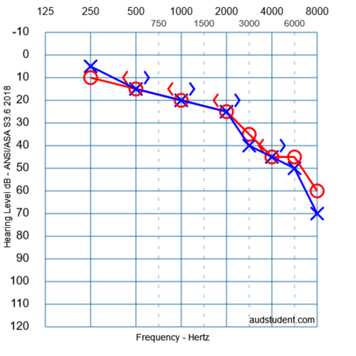 <p>sensorineural HL</p><p>3 multiple choice options</p>