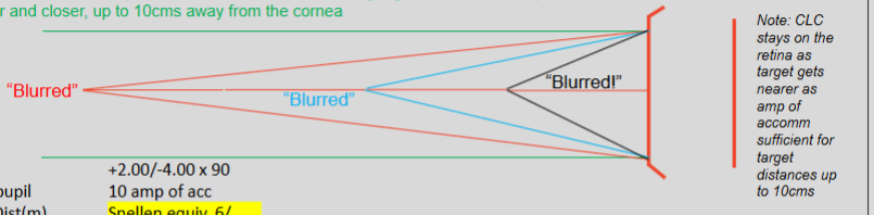 <p>4D of mixed astigmatism with an eye with 10D accom</p><p>+2.00/-4.00 × 90 </p>