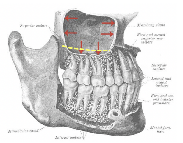 <p>Reference the attached image. The yellow dashed line represents the maxillary origin of Patient X's buccinator muscle. In the event this patient has an infection associated with M2, where will the infection spread first?</p><p>A: Buccal space <br>B: Infraorbital space <br>C: Pterygomandibular space <br>D: Vestibular space <br>E: Infratemporal space</p>