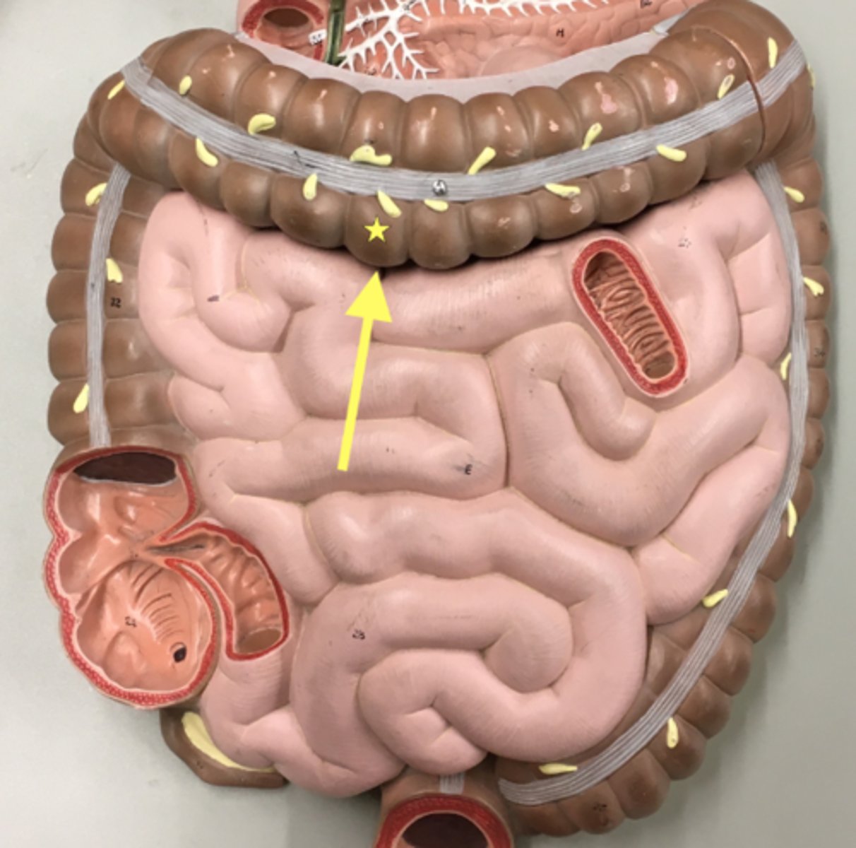 <p>Name this structure</p><p>- the out-pocketing of the large intestine</p>