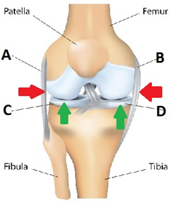 the knee is a common site of injury for athletes. Observe the figure of the right knee joint below; the articulated skeleton is shown to help with the location of the joint. There are ligaments that join the joint with the femur and tibia, called the collateral ligaments. They are shown by the red arrows. There are pads of cartilage, called the meniscus, on the tibia in which the femur moves. They are shown by the dark green arrows. 
There are two collateral ligaments and two menisci. They are named using directional terms, medial and lateral. In the figure of the knee joint, the lateral collateral ligament is shown by letter ________ and the medial meniscus is shown by letter ________. 