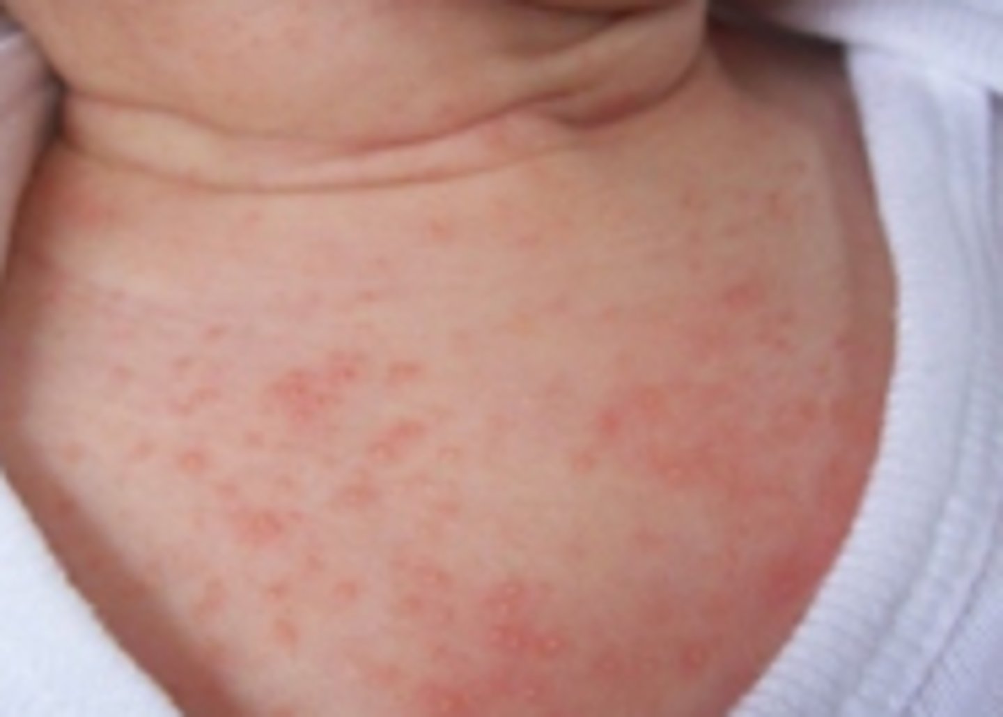 <p>first days of life</p><p>small pink pustules</p>