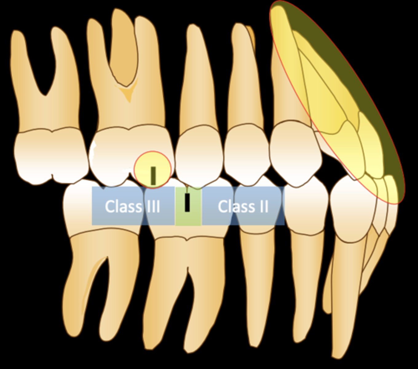 <p>- Class III molar occlusion</p><p>- Any maxillary incisor inclination</p><p>- Any amount of central incisor overject</p>