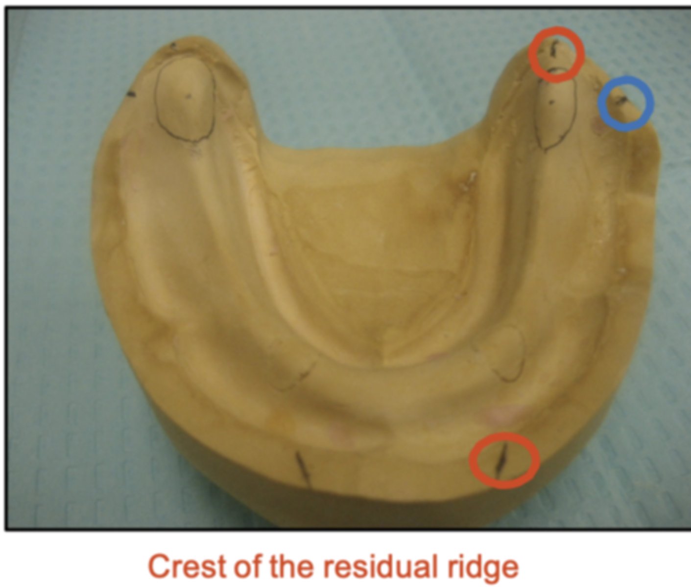 <p>It is important that we mark the crest of the mandibular ridge correctly because, if we set teeth too buccally, what would happen?</p>