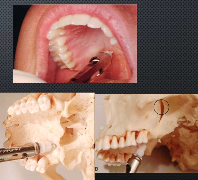 <ul><li><p>Area anesthetized: all palatal mucosa of the quadrant, pulpal for all but max molars (except MB cusp), all buccal mucosa except that of Max molars (except MB cusp) → <mark data-color="yellow" style="background-color: yellow; color: inherit;">ONLY BLOCK THAT CAN ANESTHETIZE MOST OF THE QUADRANT AT ONCE</mark></p></li><li><p>Procedure: Insert at greater palatine foramen, go 30mm and deposit cartridge slowly</p></li><li><p>Onset of action: 3-5 min</p></li><li><p>Complications: perioptical swelling, diplopia and ophthalmoplegia from possible optic nerve block, horner’s syndrome, L.A going into nose</p></li><li><p>Amount of anesthetic: 1.8ml</p></li></ul><p></p>