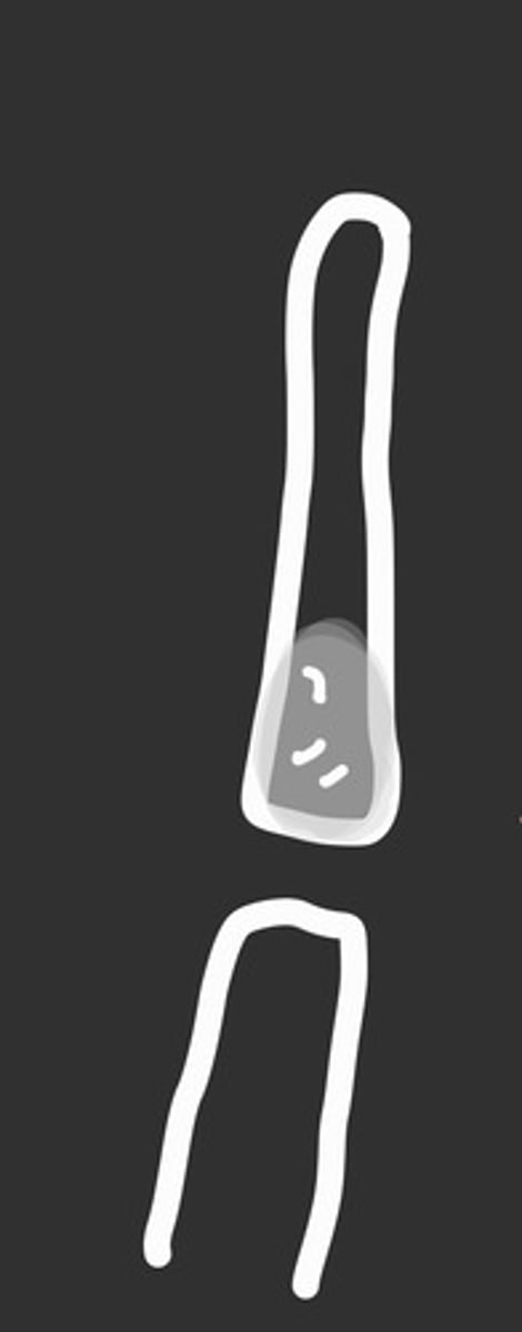 <p>presents in the extremities and is benign</p><p>what does this represent?</p>