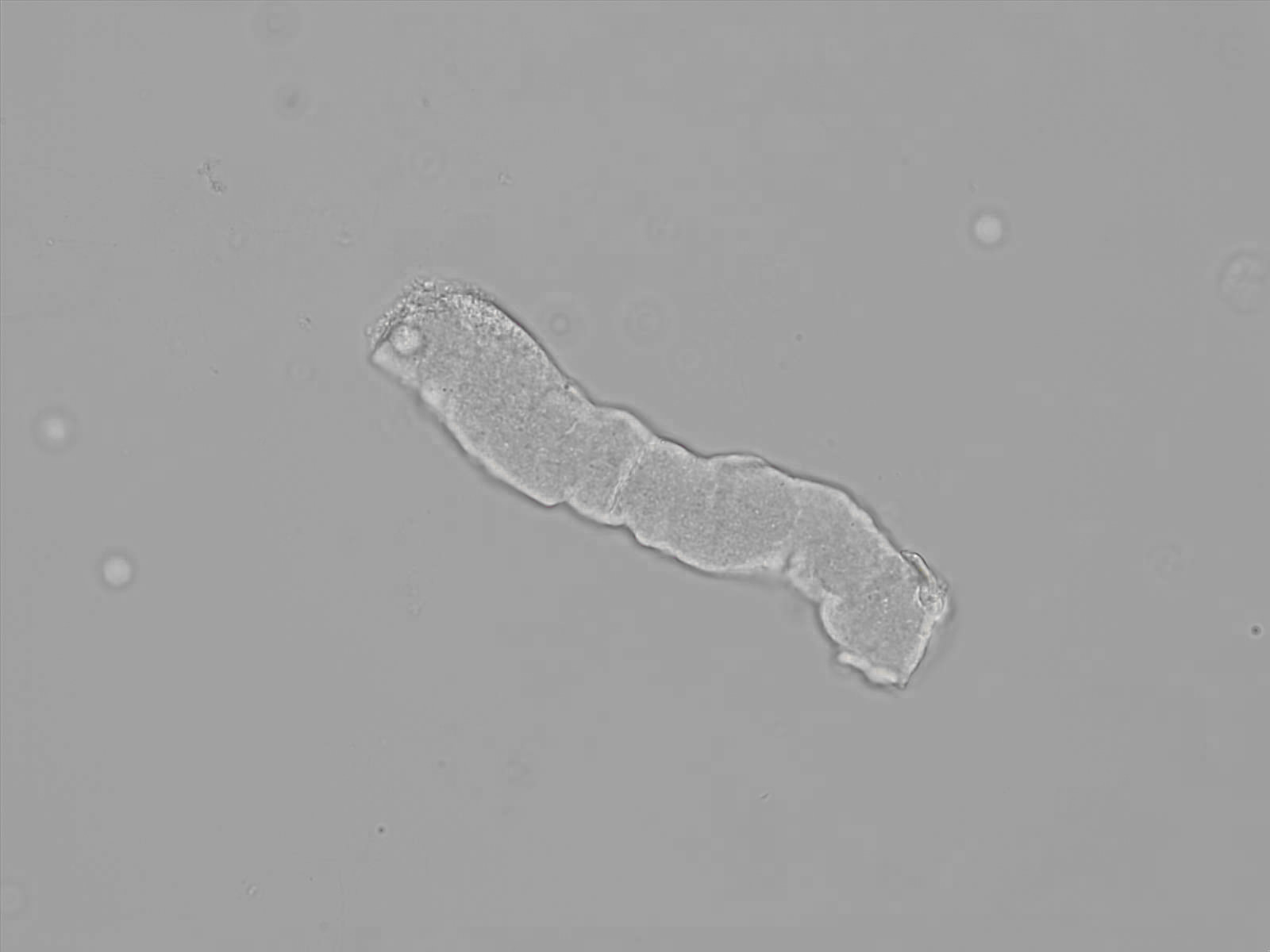 <p>chronic renal failure</p>