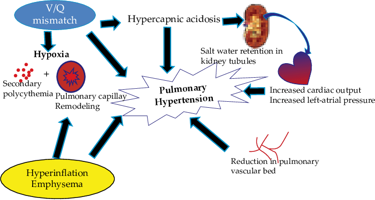 <p>KOL är en systemisk sjukdom som ger upphov till flera effekter:</p><ul><li><p><strong>Inflammation</strong>: ökad produktion av cytokiner från inflammatoriska celler i luftvägarna.</p></li><li><p><strong>Hyperkapne och hypoxi</strong>: pump- och lungsvikt ger ökat pCO<sub>2</sub> och försämrat gasutbytet (mindre diffussionsvävnad).</p></li><li><p><strong>Pulmonell hypertension</strong>: elastisk vävnad förstörs och ökat pCO<sub>2</sub> ger vasokonstriktion.</p></li></ul><p>Hyperkapne och hypoxi leder till en acidos som kompenseras av njuren → ökad natrium och vattenretention → ökat CO och blodtryck → pulmonell hypertension. Sekundär polycytemi pga ökat EPO vid hypoxi. </p>