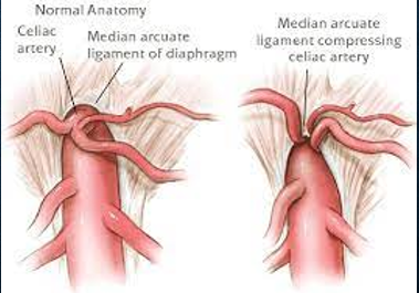 <p>MAL is a fibrous band that extends from the diaphragmatic crura and passes superior to the <strong>celiac artery</strong> </p><ul><li><p>can cause celiac artery compression during expiration which could mimic stenosis </p></li></ul><p></p>