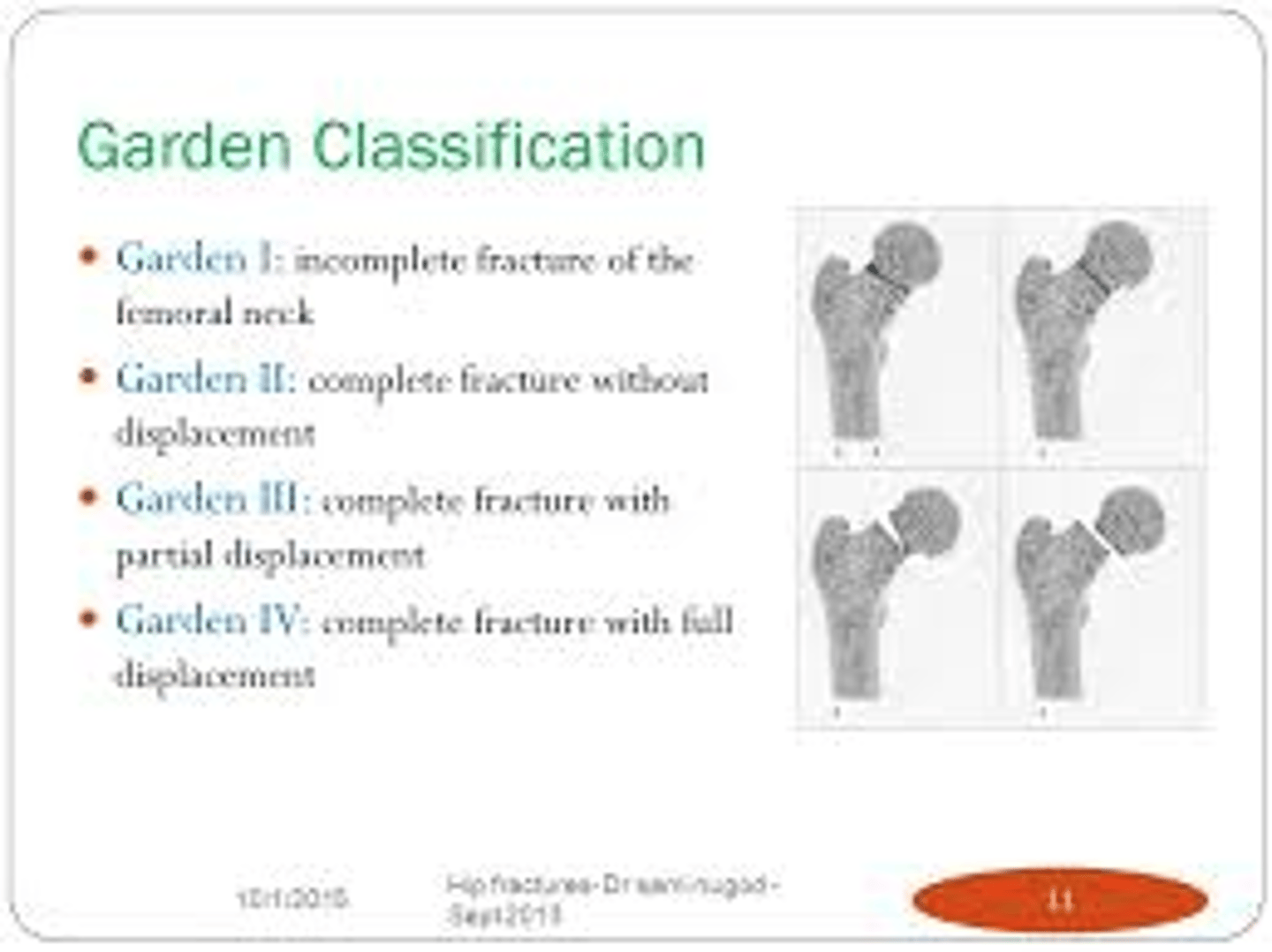 <p>Femoral neck fractures Intracapsular</p><p>Garden 1-2 ( undisplaced, stable)</p><p>- internal fixation ( dynamic hip screw/pin &amp; plate)</p><p>Garden 3-4 ( displaced , unstable)</p><p>- internal fixation ( young), hemi arthoplasty or THR ( elderly)</p><p>extracapsular</p><p>- intertrochanteric (DHS or IM nail)</p><p>- subtrochanteric IM nail</p>