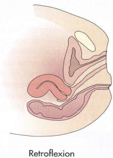 <p><u>Bending backward</u> of the uterine body on the cervix resulting in a <strong>sharp angle</strong> where it bends</p>