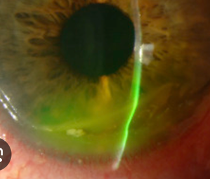 <p>Moorens ulcer: <span style="font-family: Calibri, sans-serif">inflammation of BV at limbus Associated </span><strong>with hepatitis C</strong></p><p>Objective: White marginal infiltrates that develop into a chronic serpiginous limbal ulceration over 3-12 month (peripheral crescent grey infiltrate → ulcers). </p><ul><li><p><strong>does not involve sclera unlike Peripheral ulcerative keratitis - CT disease related to RA/SLE/ etc. (PUK can be asymptomatic/pain/red/scleritis/episcleritis). </strong><span>Contact rheumatology. </span><strong>PUK below. Plan: </strong><span>Immunomodulator like cyclosporine, doxycycline, oral steroid,</span></p></li></ul><img src="https://knowt-user-attachments.s3.amazonaws.com/c638fe86-a940-437c-9cd0-37bf442a0149.png" data-width="50%" data-align="center"><p>Plan: &nbsp;Responds poorly to steroids, may speed perforation. Refer to specialist for excision/reconstruction</p>