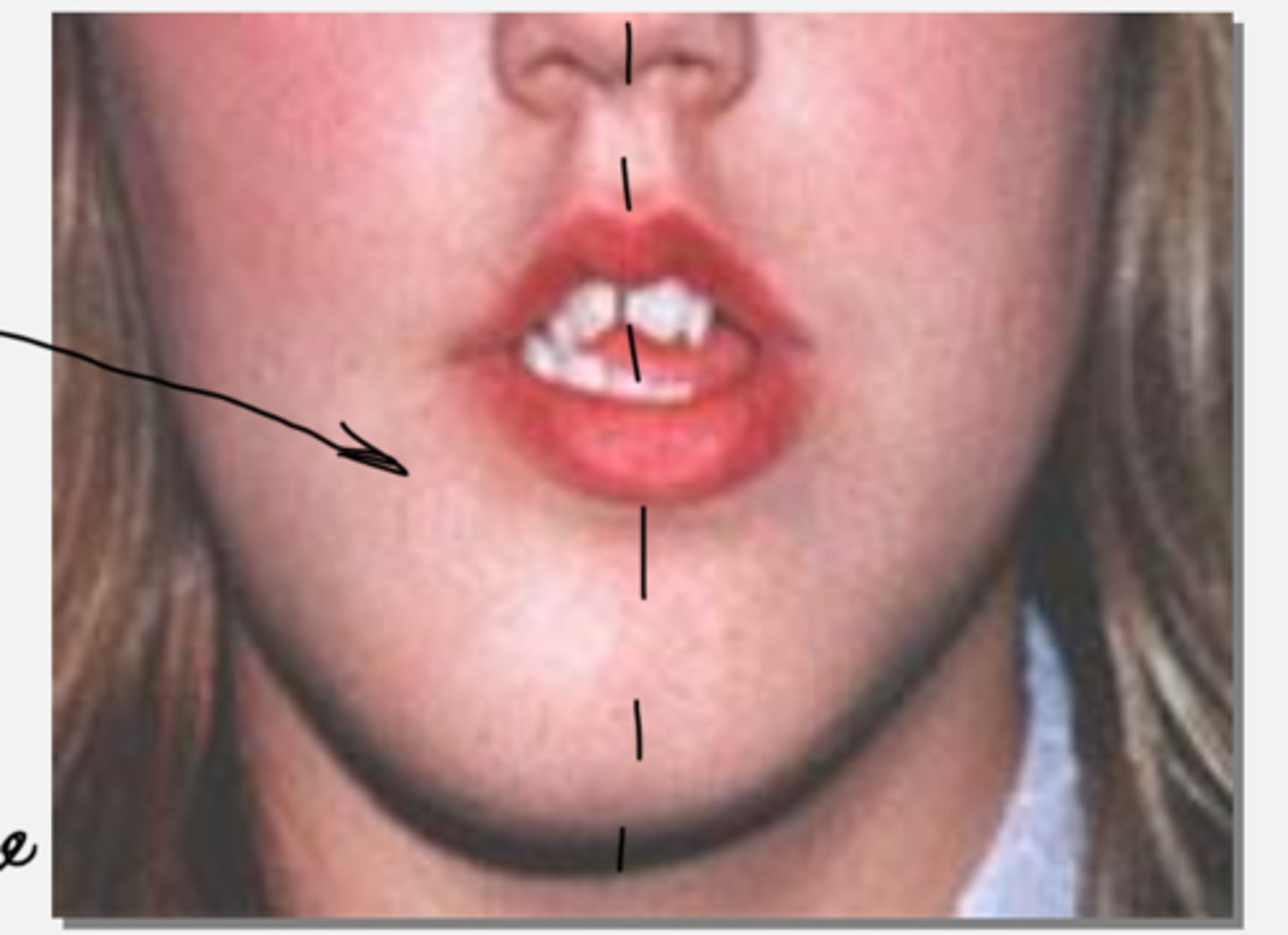 <p>Unilateral facial swelling</p>