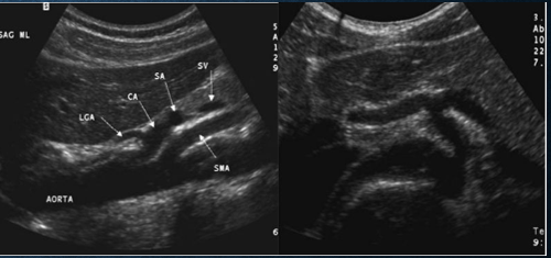 <p>anterior surface of aorta </p>