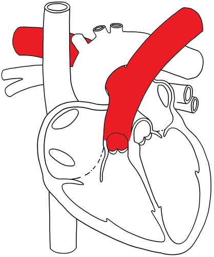 Longslagader, van het hart naar de longen.