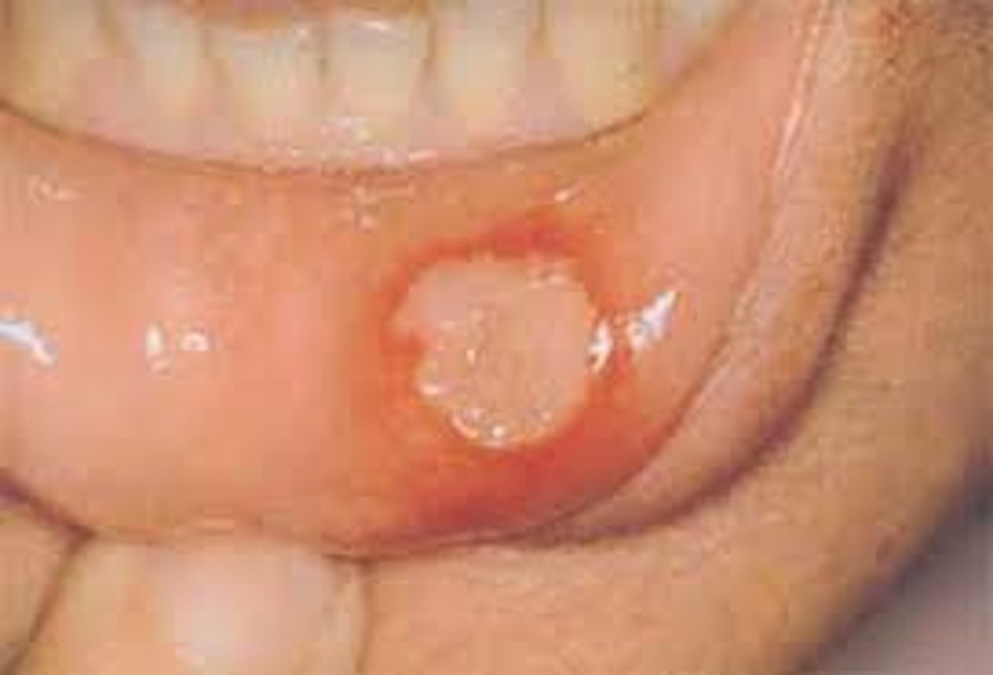 <p>larger</p><p>scarring</p><p>2-6 weeks</p><p>1-10 lessions per episode</p><p>any surface</p><p>frequent reoccurence</p><p>if in young pt. check for IBD</p>