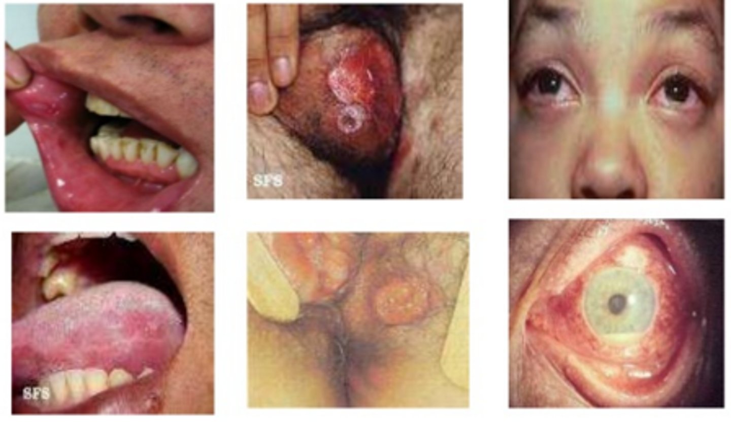 <p>ulcers of all mucous membranes</p><p>• autoimmune disease</p><p>• population: young adults - asian</p>