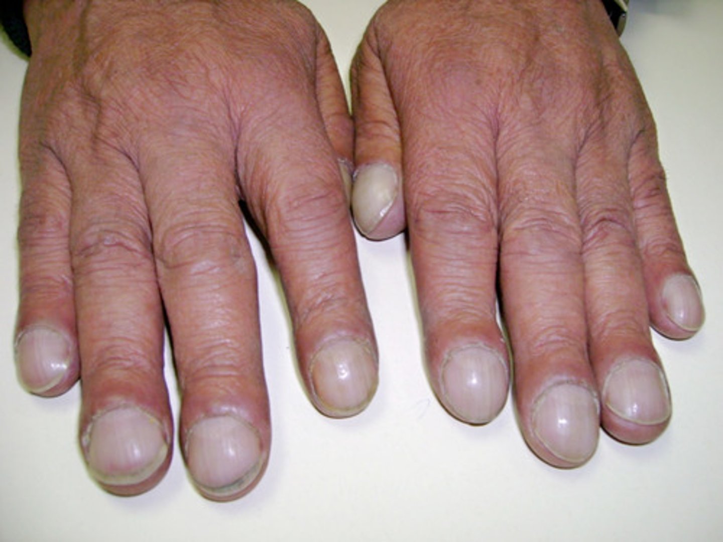 <p>= klinisch beeld gelinkt aan COPD</p>