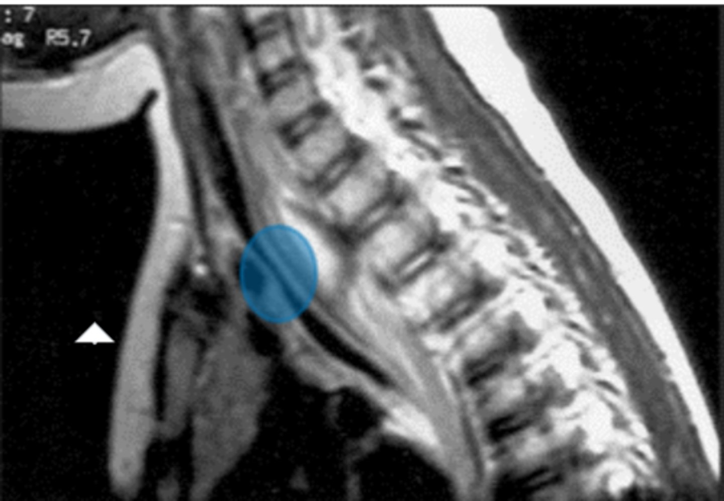<p>Label the highlighted pathology in the image below</p>
