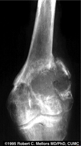 <p>The femur is prone to tumors – benign and malignant</p><p></p><p><strong>___________</strong> – chondrosarcoma, metastases</p>
