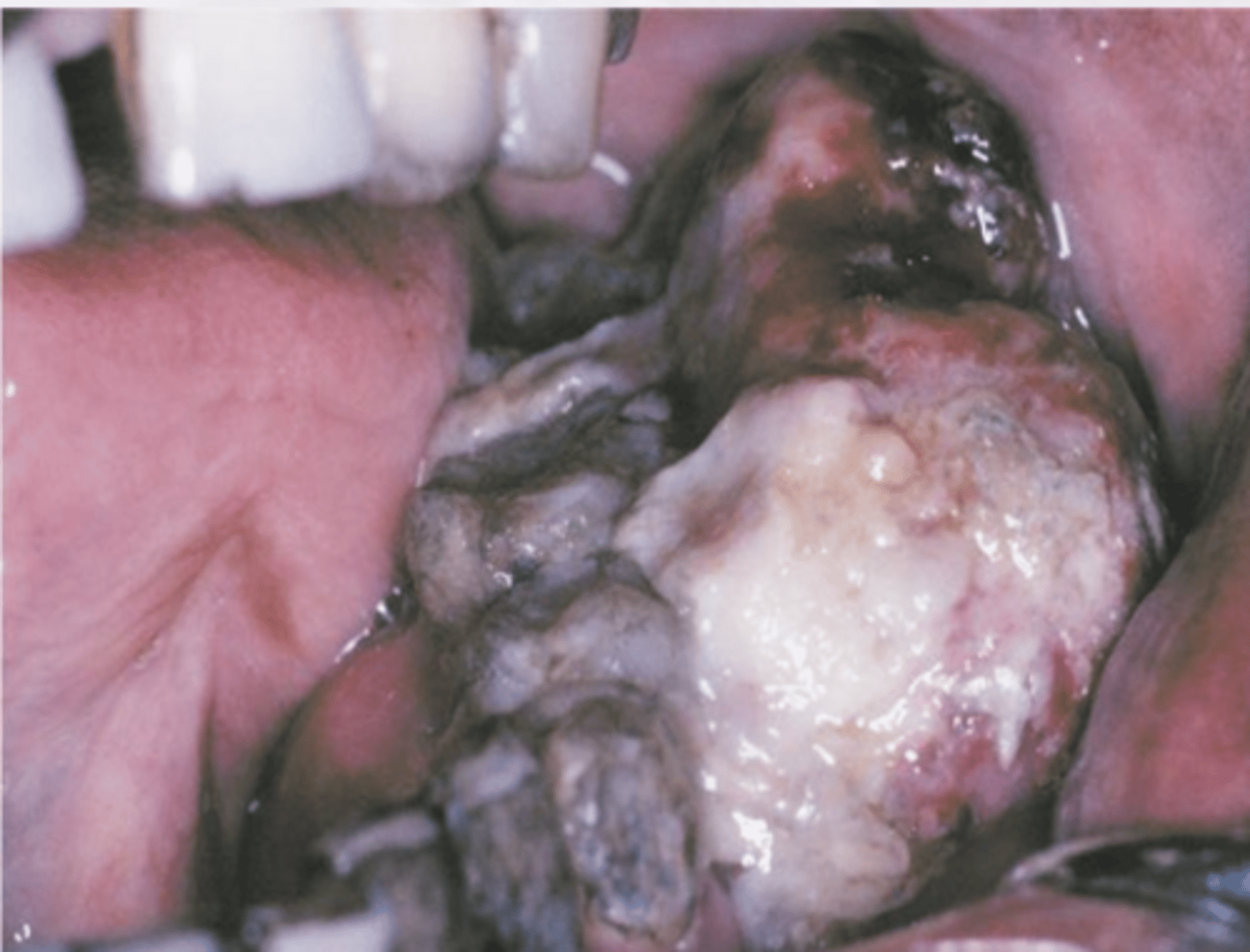 <p>Common in people with neurofibromas (50%)</p><p>10% of all soft tissue sarcomas</p>