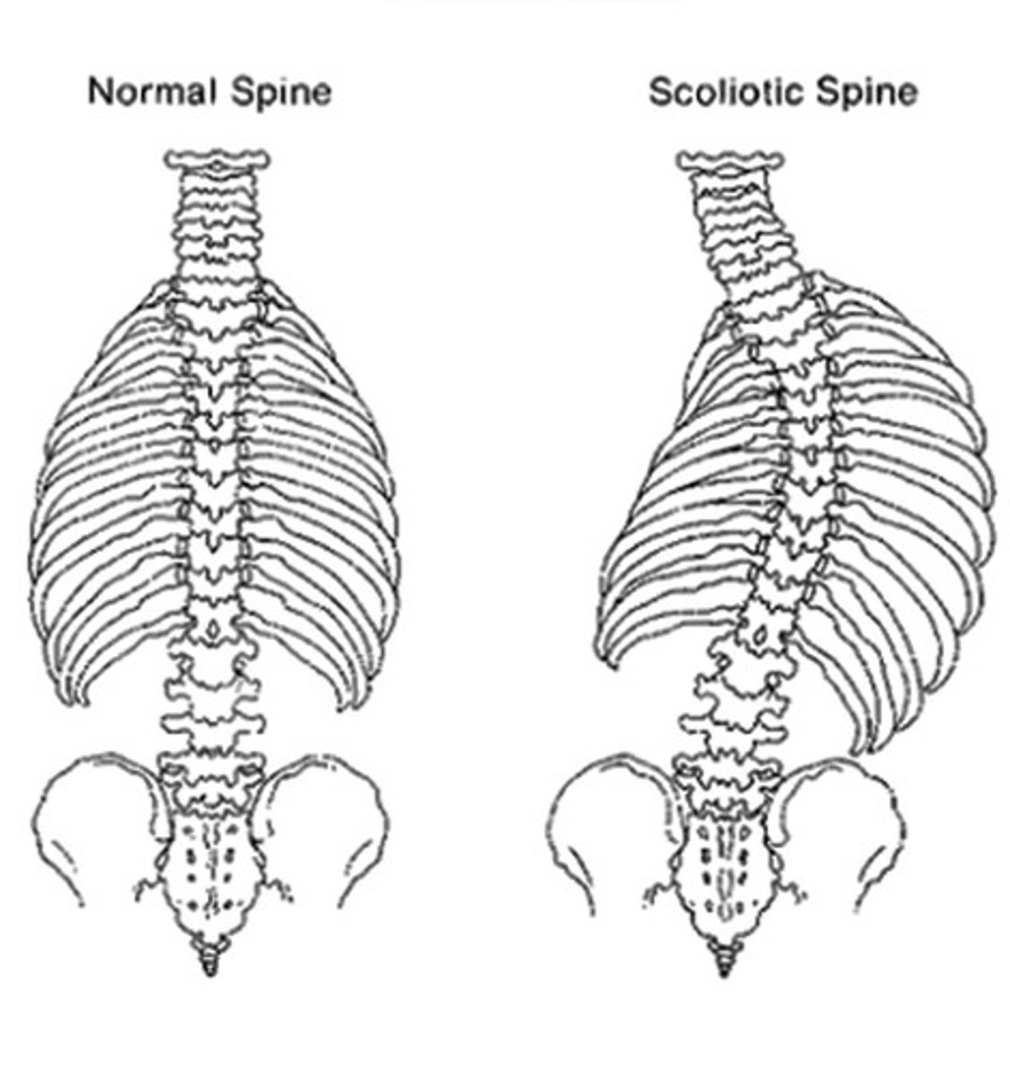 <p>-Scoliosis - lateral curvature of the spine.</p><p>Usually treated with body braces or surgery when young</p><p>Lateral curvature is abnormal!!.</p>