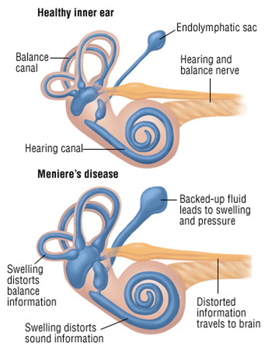 <p>Meniere disease:</p><p>excess of endolymph fluid in the inner ear</p>